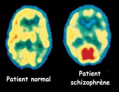 Schizophrenie-observee-par-Pet-scan2