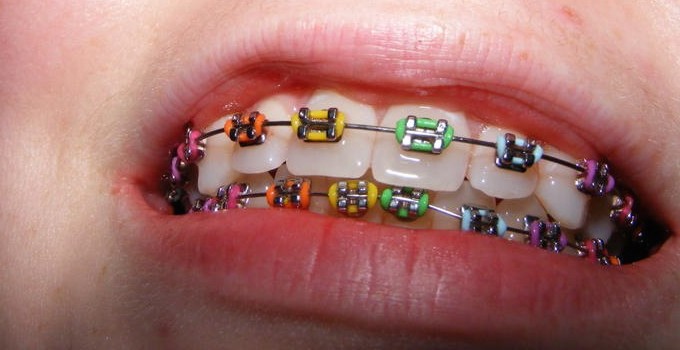 Appareil-Dentaire-couleur-élastique