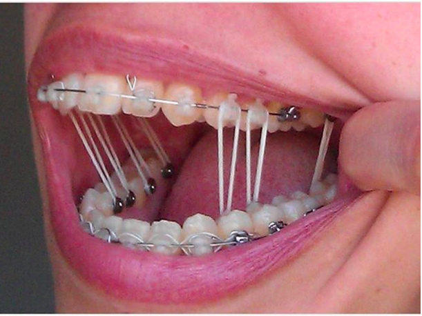 appareil dentaire horrible enfance (5)